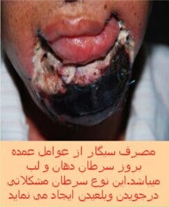 Iran 2009 Health Effects Mouth - mouth cancer, gross, lived experience